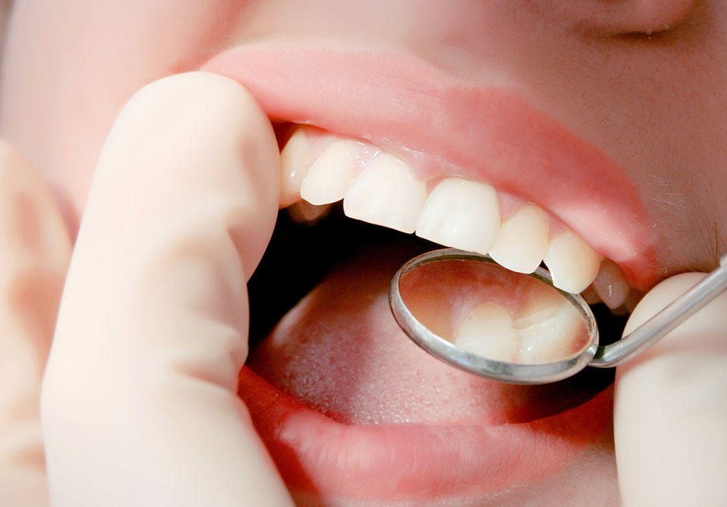 痛みに配慮した抜歯