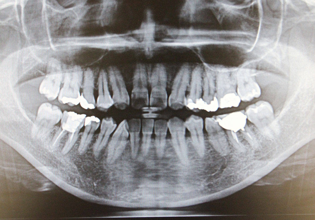 親知らずの状態のご説明